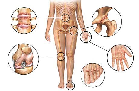 Полиостеоартроз — лечение суставов и кистей - изображение 1