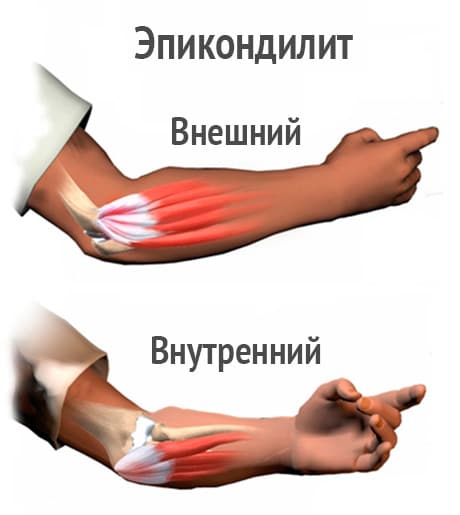 Латеральный эпикондилит локтевого сустава симптомы и лечение фото