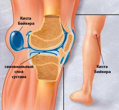 Синовит коленного сустава: причины, симптомы, лечение - Центр доктора Бубновского