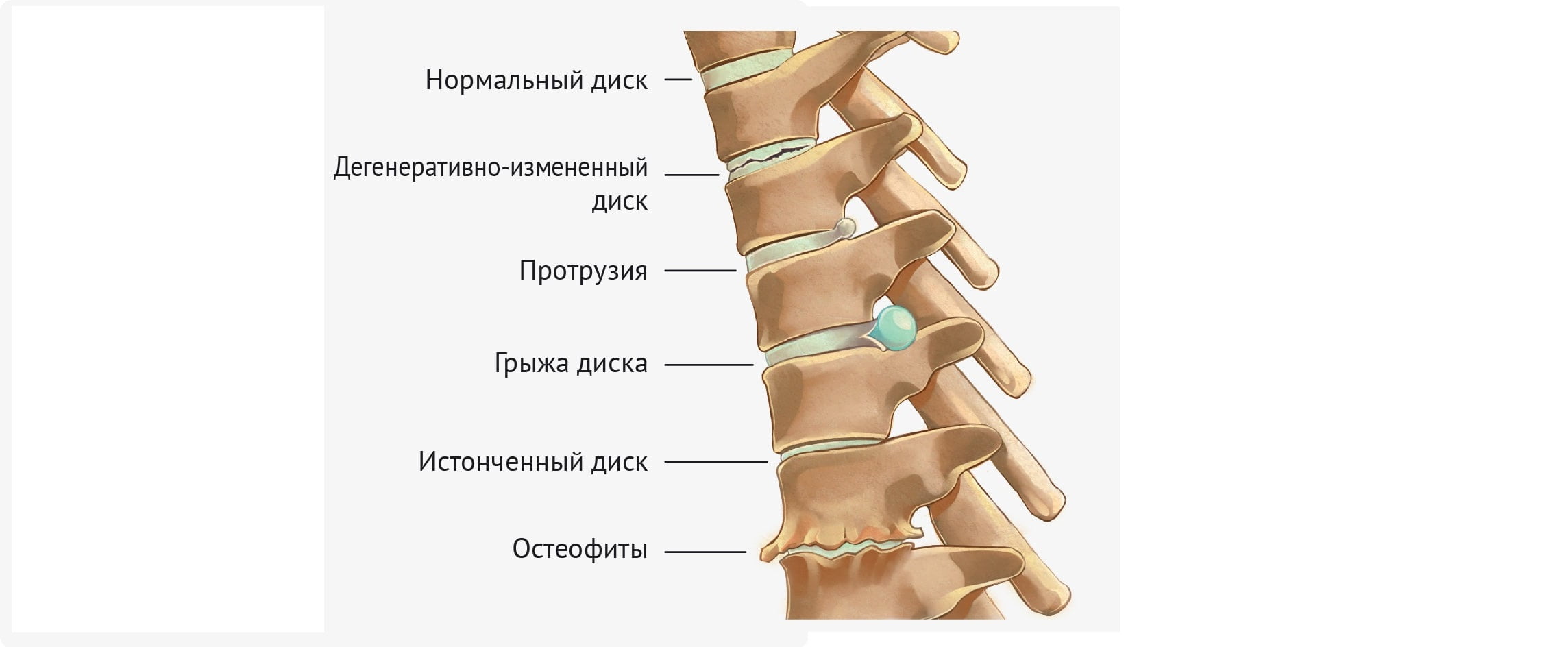 Картина дегенеративных изменений пояснично крестцового отдела. Смещенный диск позвоночника. Смещение дисков шейного отдела позвоночника. Смещение позвонков поясничного отдела.