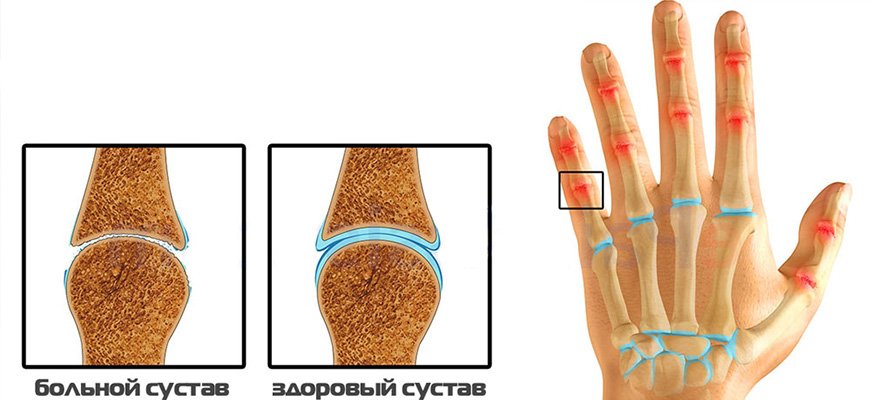 Травматический артроз кисти рук и его лечение thumbnail