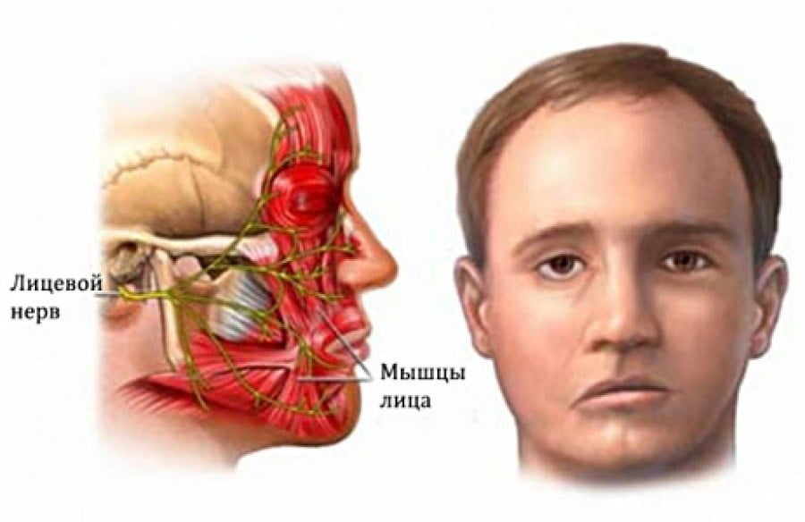 Фото воспаление лицевого нерва симптомы и лечение