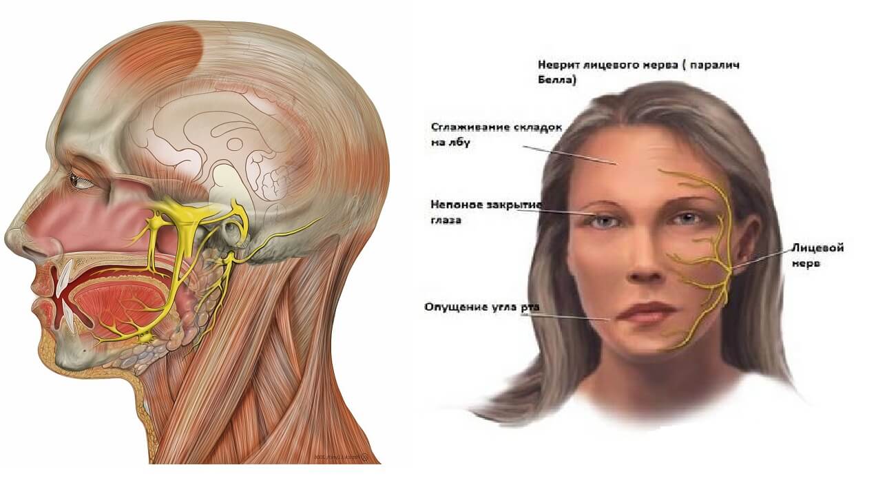 Лицевой нерв справа. Неврит воспаление нерва. Воспаление тройничного нерва. Неврит тройничного лицевого нерва. Неврит тройничного нерва лекарства.