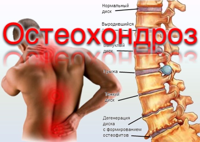 Грудной остеохондроз картинки