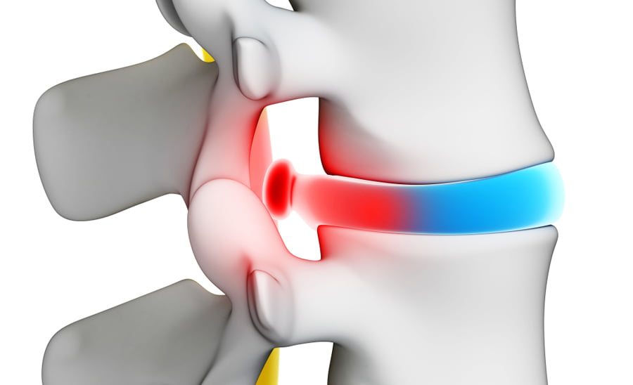 Что такое грыжа позвоночника фото