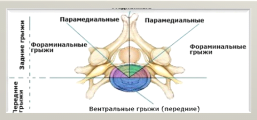 Парамедиальная грыжа позвоночника. Медиально-парамедиальная грыжа l5/s1. Медианно-парамедианная фораминальная грыжа диска. Медианно-парамедианная грыжа l5-s1 правосторонняя. Медианно-парамедианная грыжа диска l4-l5.